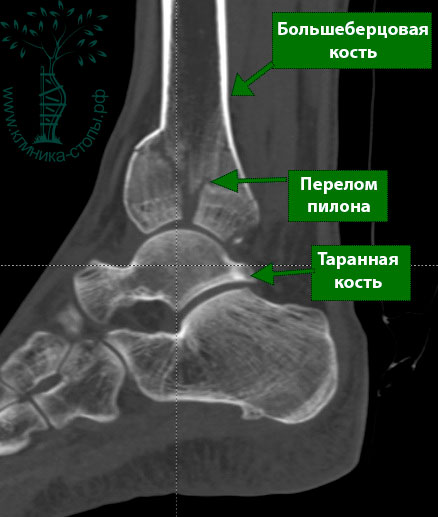 Реферат: Перелом диафизов обеих костей правой голени